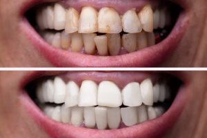 Vita tänder hemma enklare än du tror